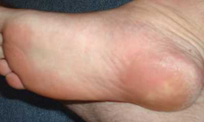 Как выглядят шпоры на ногах