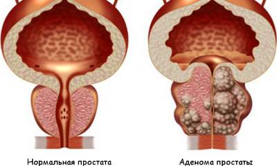 Аденома простаты у мужчин
