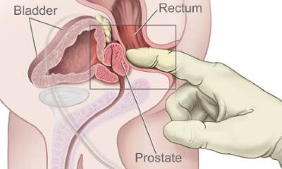 Где находится простата у мужчин