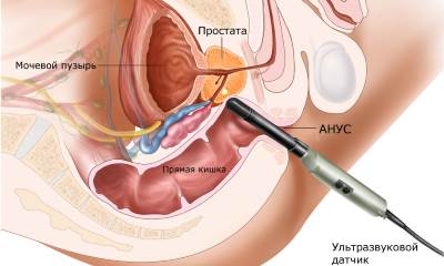 Как делается узи простаты у мужчин