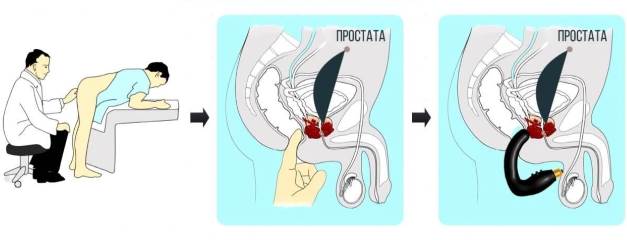 Как делать массаж простаты