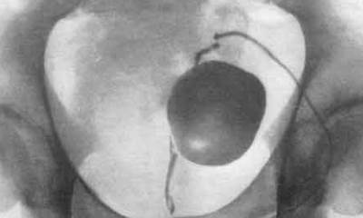 Киста предстательной железы