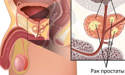 Рак простаты у мужчин