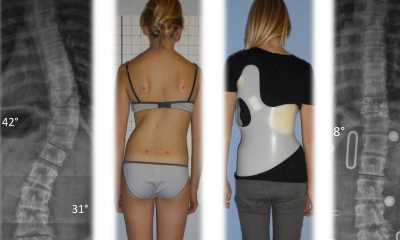 S-образный сколиоз 3 степени