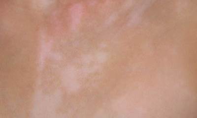 Белые пятна