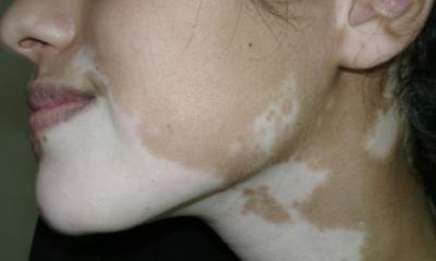 Болезнь витилиго