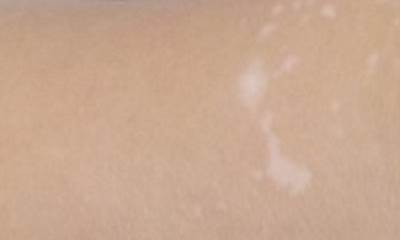 Витилиго в начальной стадии