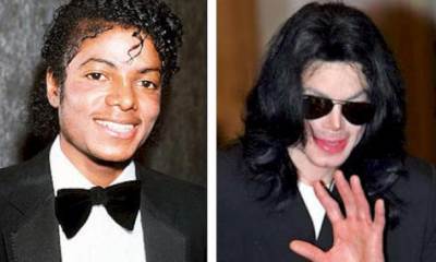 Витилиго у Майкла Джексона