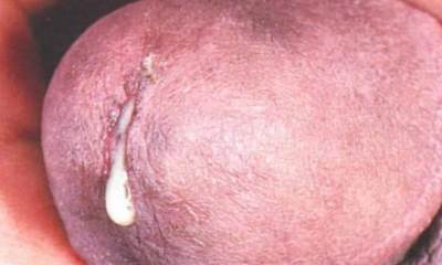 Выделения при простатите