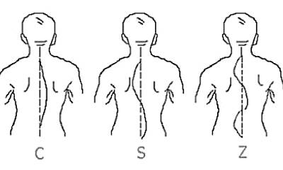 Детский сколиоз