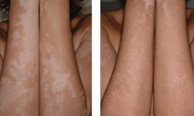 Лечение витилиго до и после