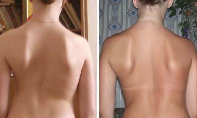 Лечение сколиоза у детей