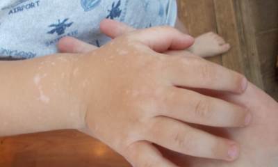 Начальная стадия витилиго у детей