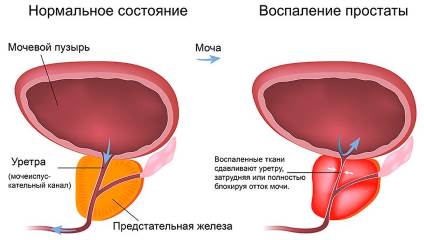 Простатит у мужчин