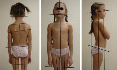 Сколиоз 1 степени у детей