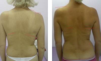 Сколиоз 1 степени