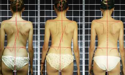 Сколиоз 2 степени