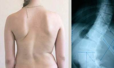 Сколиоз 2 степени