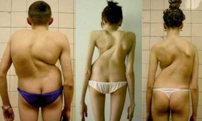 Сколиоз 4 степени