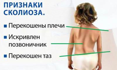 Сколиоз позвоночника у детей
