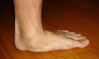 Плоскостопие 3 степени