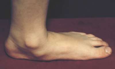 Плоскостопие 4 степени