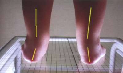 Симптомы плоскостопия у детей