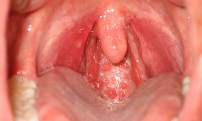 Герпес в горле у взрослых