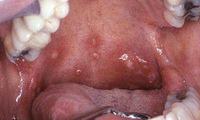 Герпес во рту у взрослых