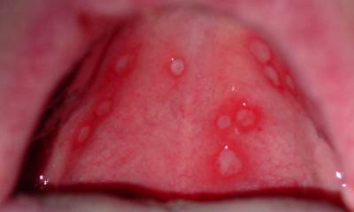 Герпес во рту у ребенка