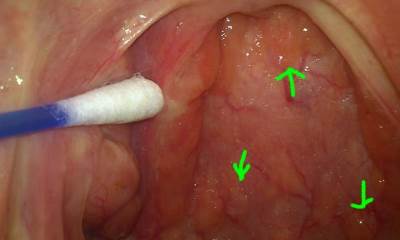 Герпес на задней стенке горла