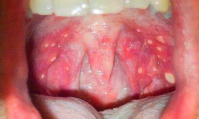 Герпес на миндалинах