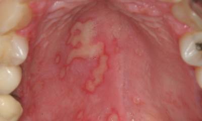 Герпес на небе