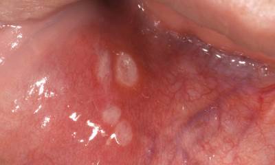 Герпес на слизистой рта
