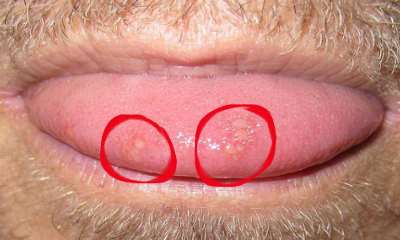 Герпес на языке у взрослых