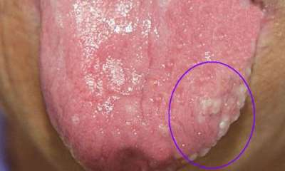 Герпес на языке у ребенка