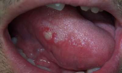 Герпес на языке