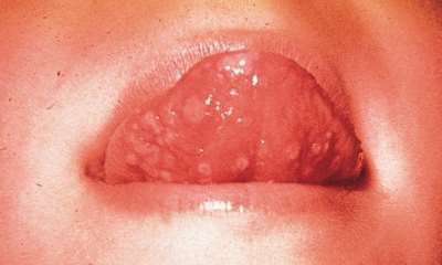 Герпес под языком