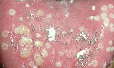 Герпес языка