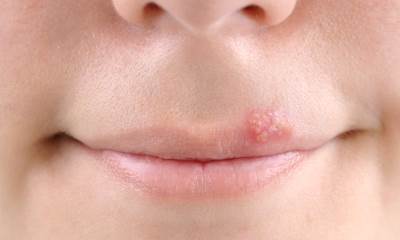 Герпес на губах у детей