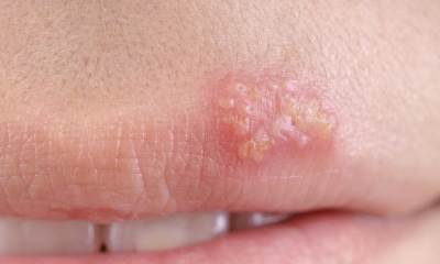 Начальная стадия герпеса на губах