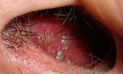 Герпес в носу