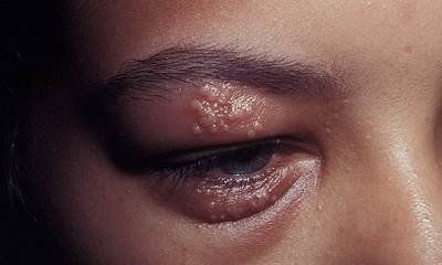 Герпес на веке глаза