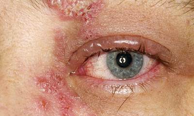 Герпес на глазах