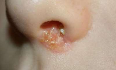 Герпес на носу у ребенка