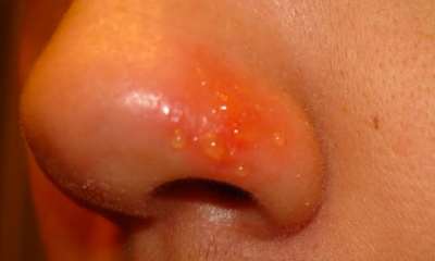 Герпес на носу