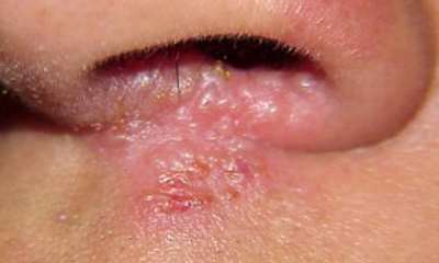 Герпес под носом