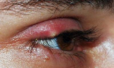 Простуда на глазу