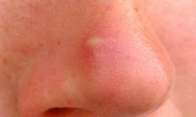 Простуда на носу