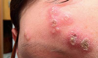 Герпес на лбу